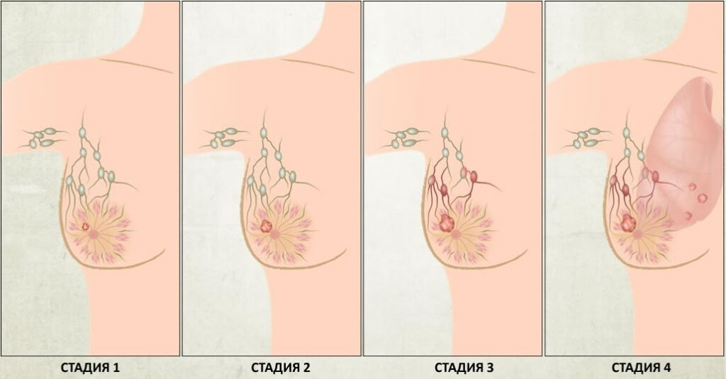 Лечение рака груди на ранних стадиях