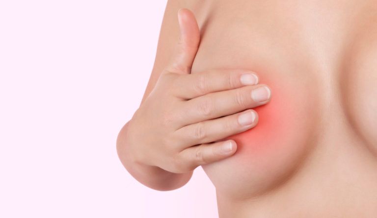 галактоцеле при вагітності