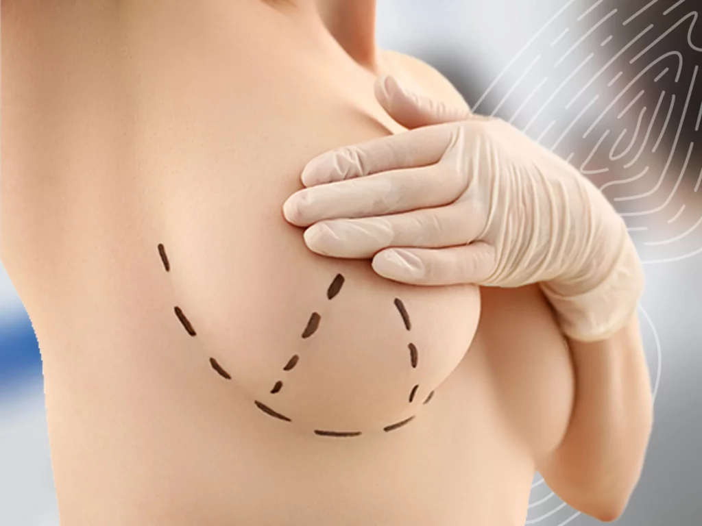 що таке мастектомія