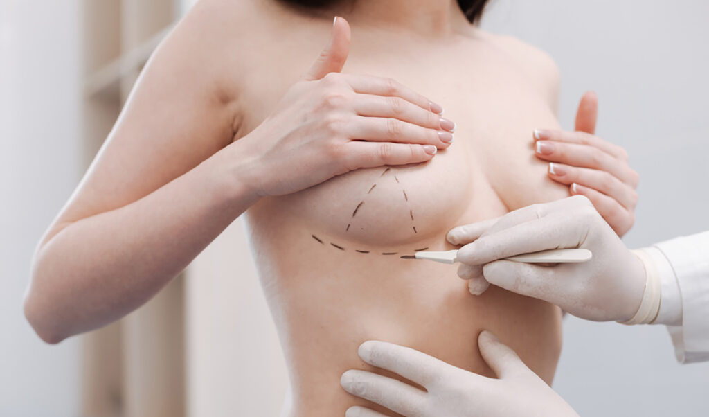 видалення молочної залози