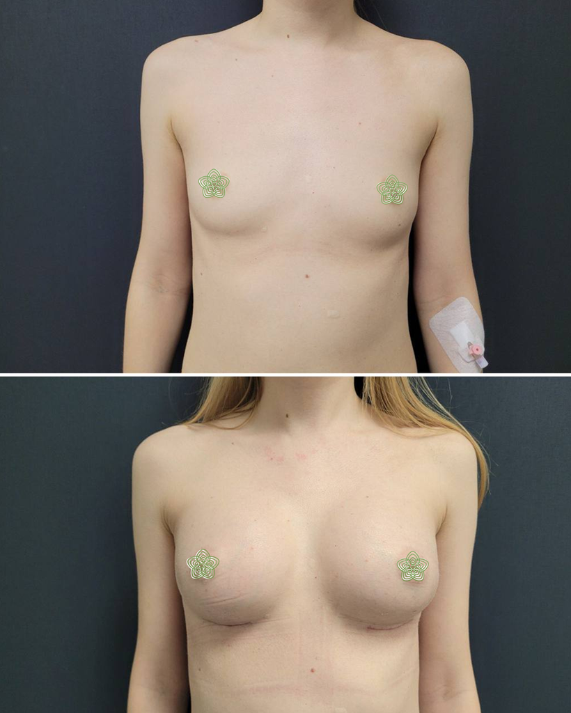 аргументаційна мамопластика до і після