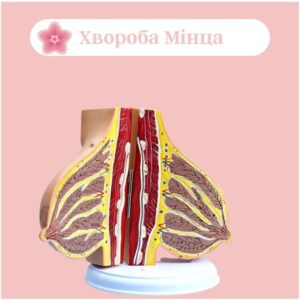 хвороба мінца