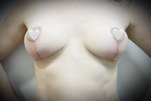 Мастопексия, фото до и после 4. Подтяжка груди в Киеве