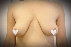 Мастопексія, фото до та після 2. Підтяжка грудей у Києві