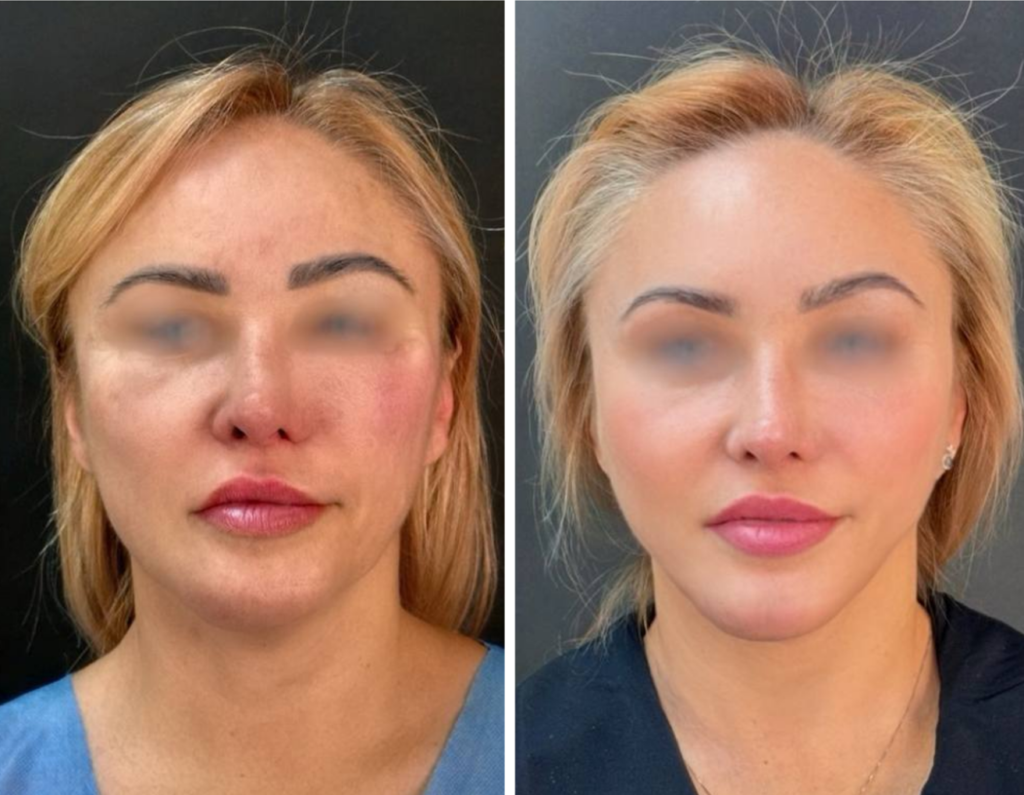 фейслифтинг до и после