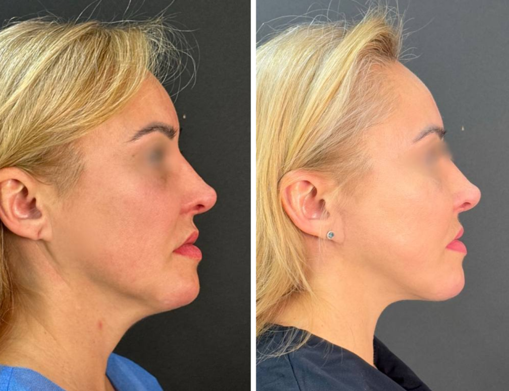 подтяжка лица и шеи до после