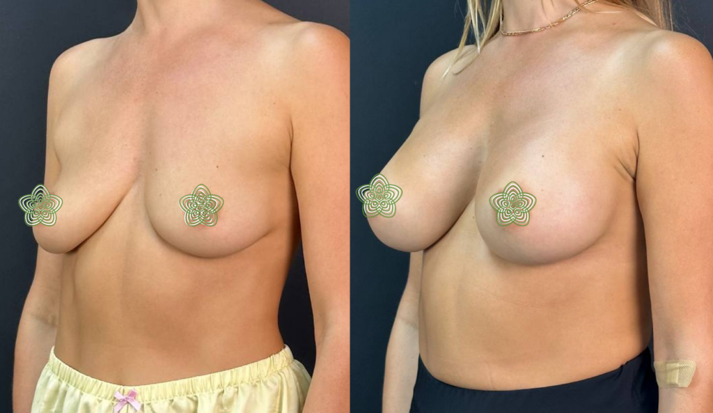 до та після збільшення грудей фото