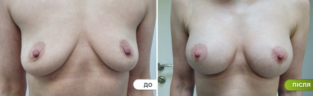 до и после маммопластики