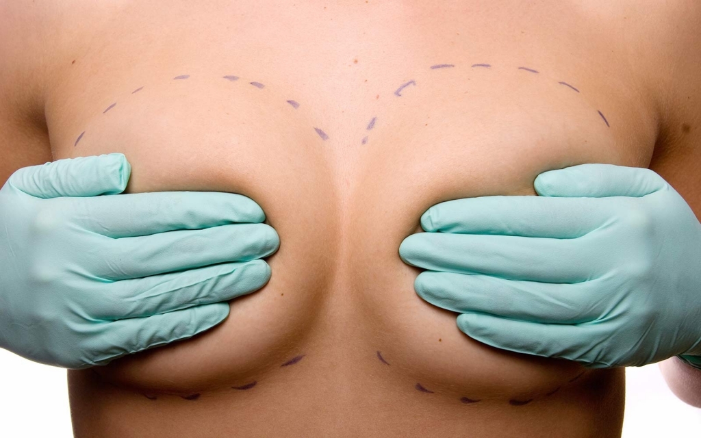 увеличение груди с циркулярной подтяжкой