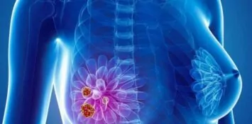 Медицинская визуализация молочной железы с очагом новообразования.