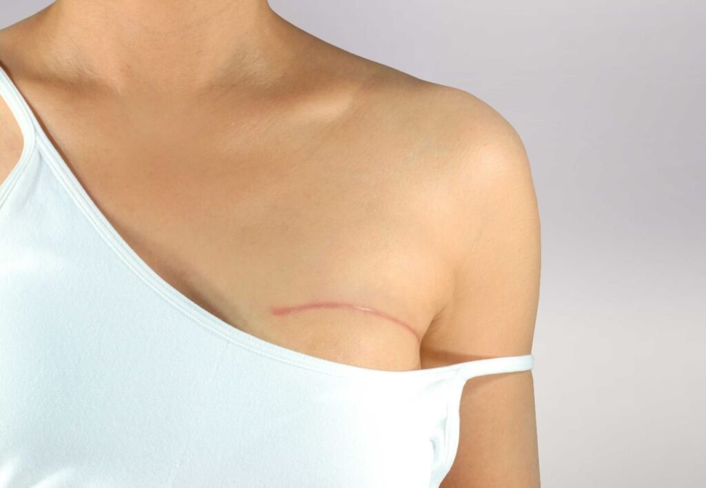 Фото Установление метки в опухоль молочной железы