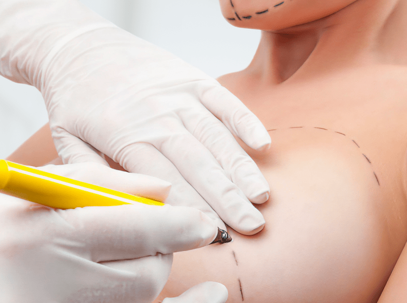 Фото Встановлення мітки в пухлину молочної залози