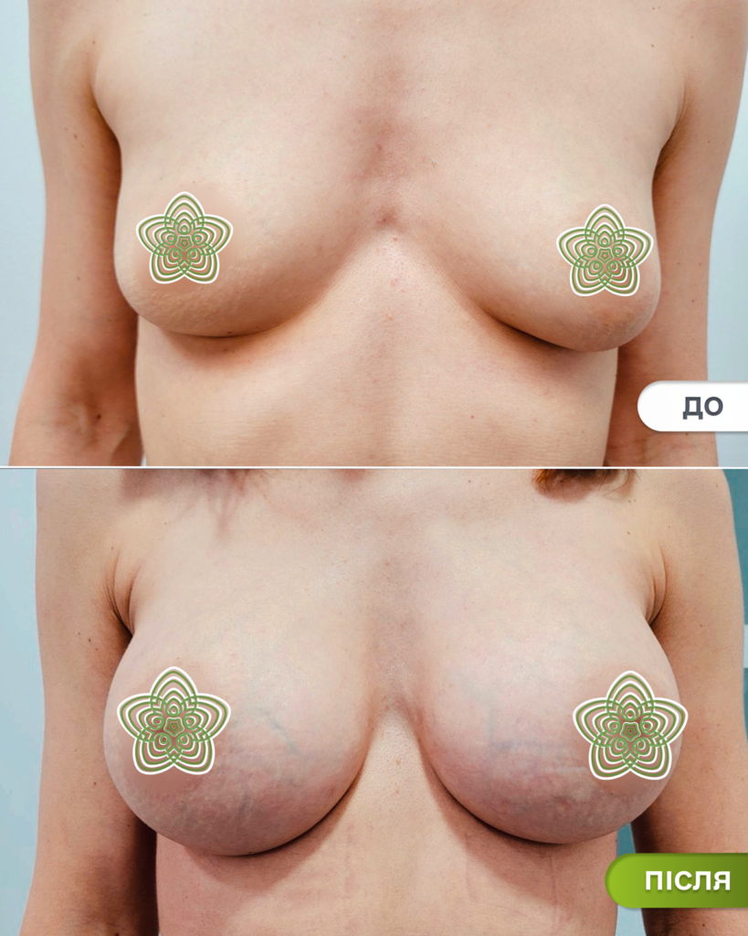 Фото Увеличение груди: до и после